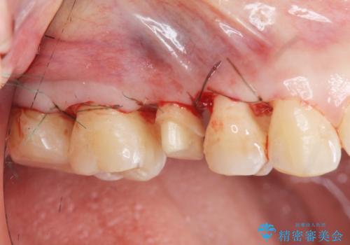 放置した虫歯を外科を行い抜歯を回避の治療前