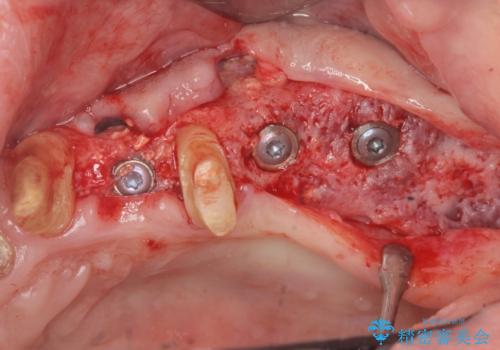 骨の造成を行った上顎インプラント治療の治療中