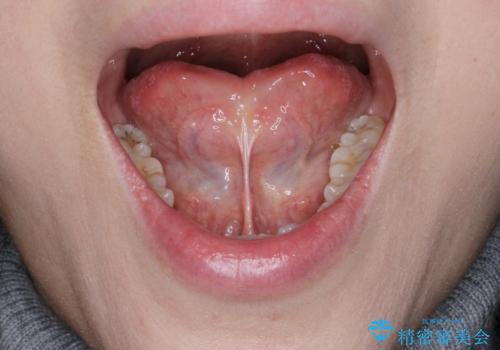 滑舌を改善したい　舌小帯の形成術の治療前