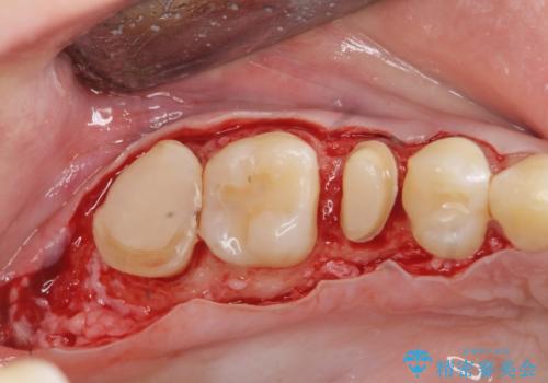 放置した虫歯を外科を行い抜歯を回避の治療前