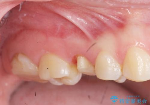 放置した虫歯を外科を行い抜歯を回避の治療中