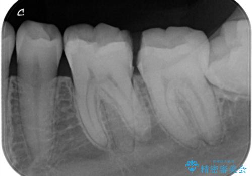 他院で虫歯と言われた。の治療前