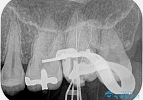 【精密根管治療】奥歯がズキズキ痛い。の治療中