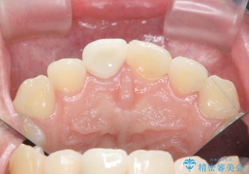 歯ぐきにできものができた 前歯の色調改善の治療後