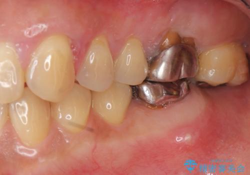 強い咬合力に対抗する歯周補綴の治療前