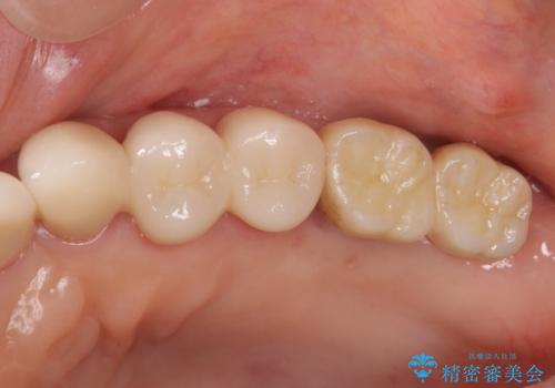 強い咬合力に対抗する歯周補綴の治療後