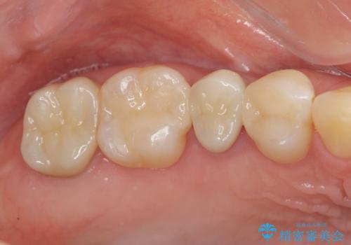放置した虫歯を外科を行い抜歯を回避の症例 治療後