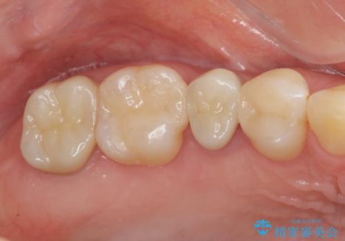 放置した虫歯を外科を行い抜歯を回避の治療後