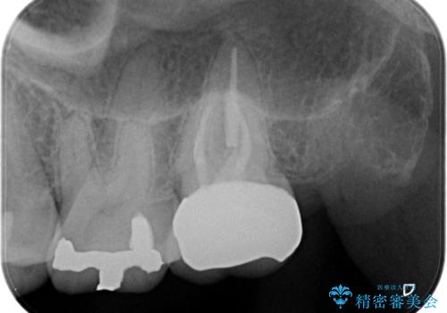 【精密根管治療】奥歯がズキズキ痛い。の治療後
