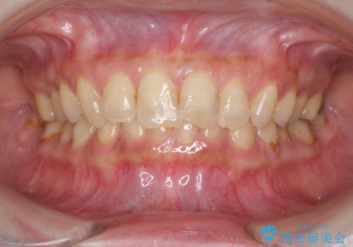 [ 審美歯科 ]  歯並び・色・形を改善!　セラミッククラウン治療の治療前