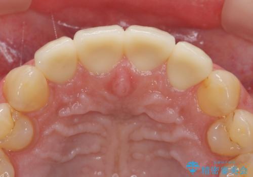 [ 審美歯科 ]  歯並び・色・形を改善!　セラミッククラウン治療の治療後