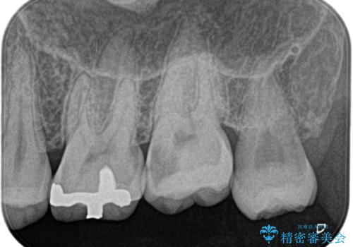 【精密根管治療】奥歯がズキズキ痛い。の治療前