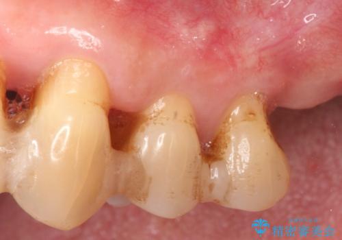 強い咬合力に対抗する歯周補綴の治療前