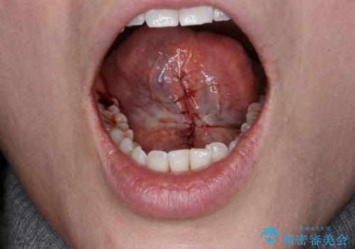 滑舌を改善したい　舌小帯の形成術の治療中