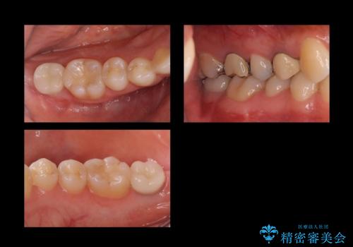 歯科でトラウマ 怖くて行っていなかったが、今度こそきちんと治療したいの治療後