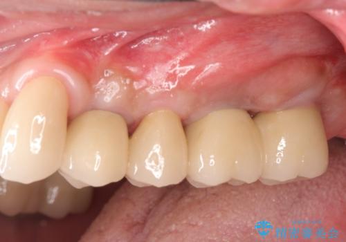 骨の造成を行った上顎インプラント治療の治療後