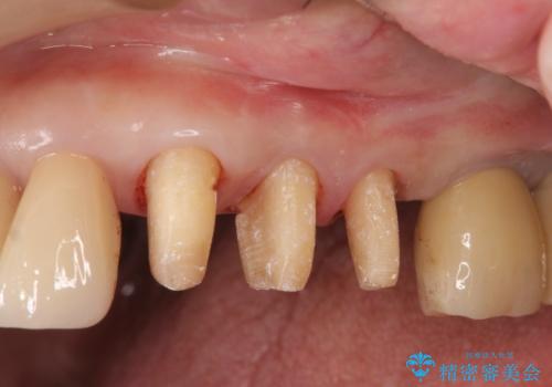 強い咬合力に対抗する歯周補綴の治療中