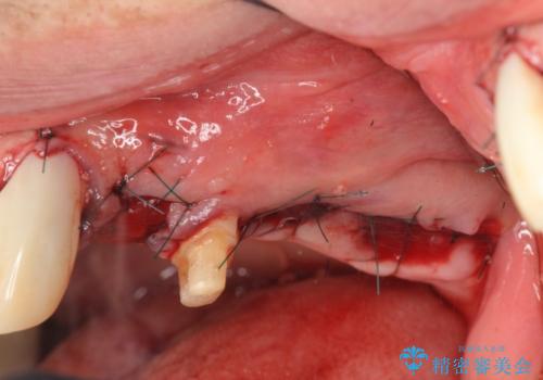 骨の造成を行った上顎インプラント治療の治療前