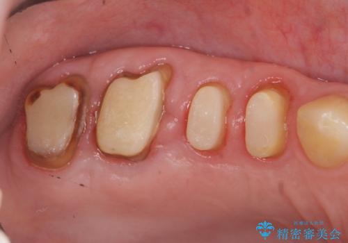 根管治療・歯周外科を行い歯を残した、複合的虫歯治療の治療中
