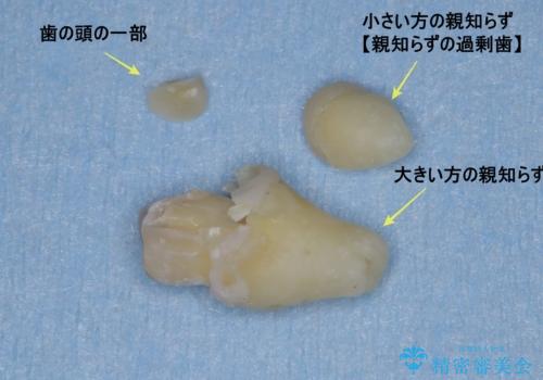 【埋伏智歯と埋伏智歯の過剰歯の抜歯】埋まっている親知らず2本の抜歯の治療後