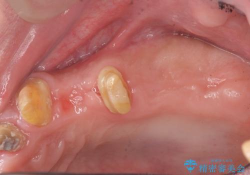 骨の造成を行った上顎インプラント治療の治療中