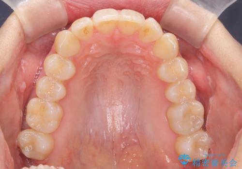 目立つ前歯のガタつきを改善! マウスピース矯正治療の治療後