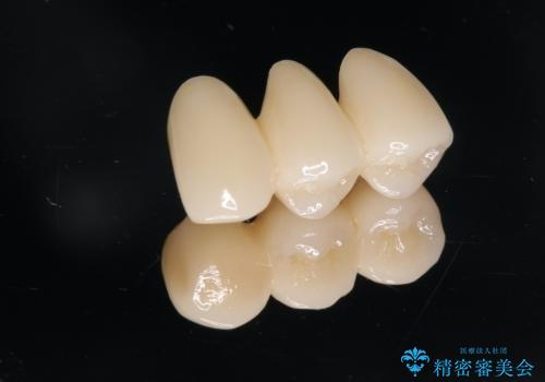 強い咬合力に対抗する歯周補綴