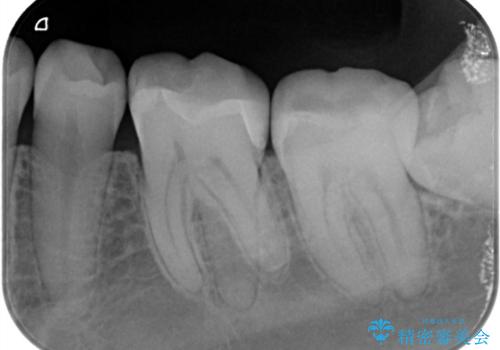 他院で虫歯と言われた。の治療後