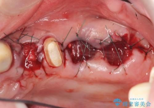 骨の造成を行った上顎インプラント治療の治療前