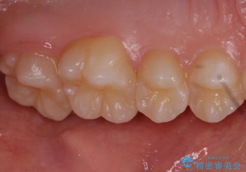他院で治療した部分の気泡 セラミックインレーでの修復の治療前