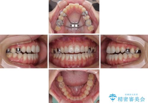 【モニター】狭い上顎歯列とオープンバイト　急速拡大装置を用いた矯正治療の治療中