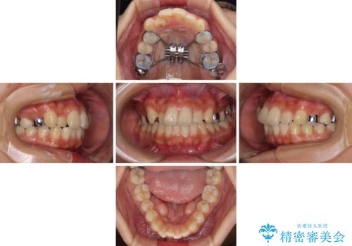 【モニター】歯列が狭くデコボコが気になる 急速拡大装置を用いたインビザライン矯正の治療中