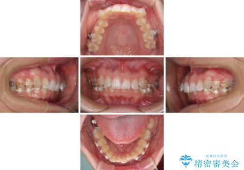カリエール・ディスタライザーとインビザラインを用いた前歯の咬み合わせ改善の治療中