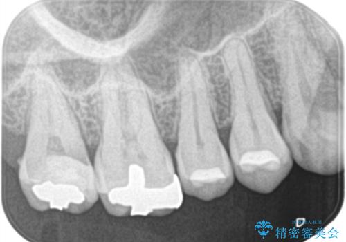 【オールセラミック】歯がズキズキ痛い。の治療前