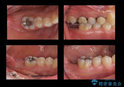 歯科でトラウマ 怖くて行っていなかったが、今度こそきちんと治療したいの治療前