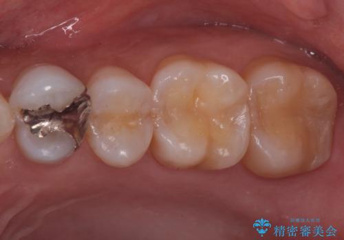 銀歯と樹脂の詰め物のやり替え セラミックインレーでの治療