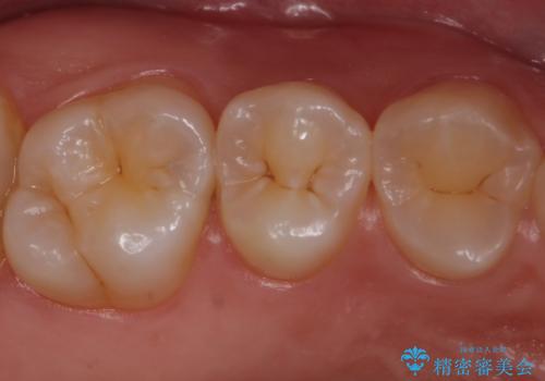 歯と歯の間の虫歯 セラミックインレーでの治療の治療前