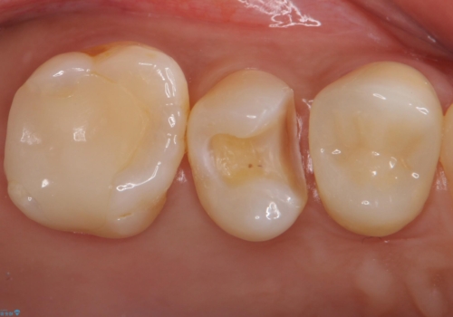 銀歯を白くしたいの治療中