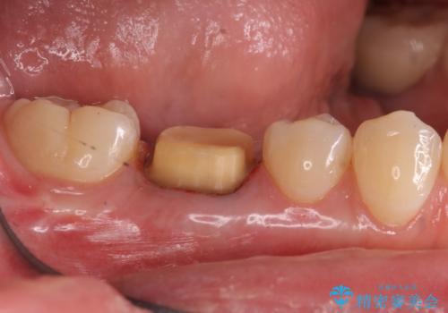 樹脂をセラミックにしたい ジルコニアクラウンでの治療の治療中