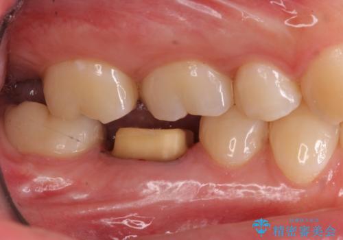 樹脂をセラミックにしたい ジルコニアクラウンでの治療の治療中