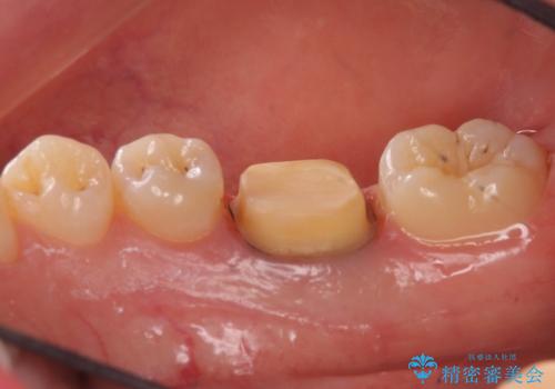 樹脂をセラミックにしたい ジルコニアクラウンでの治療の治療中