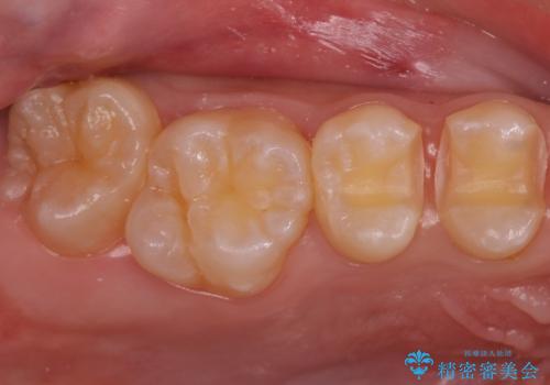 歯と歯の間の虫歯 セラミックインレーでの治療の治療中