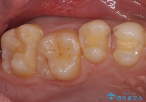 歯と歯の間の虫歯 セラミックインレーでの治療の治療中