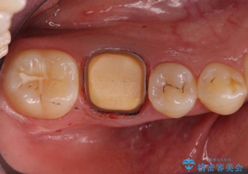 樹脂をセラミックにしたい ジルコニアクラウンでの治療の治療中