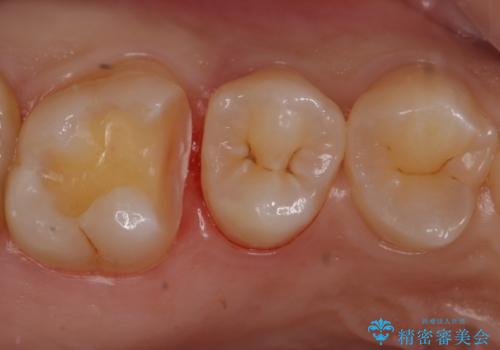 歯と歯の間の虫歯 セラミックインレーでの治療の治療中