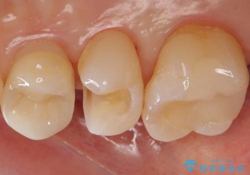 銀歯を白くしたいの治療中