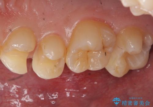 歯と歯の間の虫歯 セラミックインレーでの治療の治療中