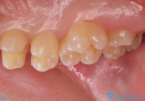 歯と歯の間の虫歯 セラミックインレーでの治療の治療中