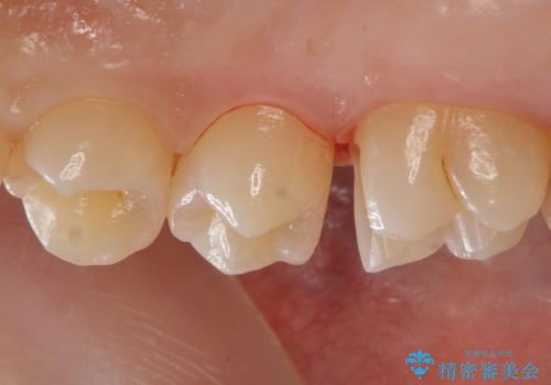 歯と歯の間の虫歯 セラミックインレーでの治療の治療中