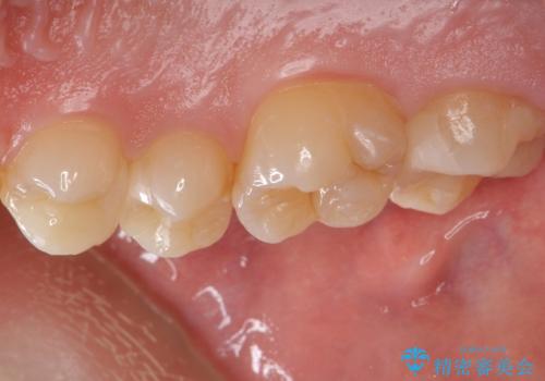 歯と歯の間の虫歯 セラミックインレーでの治療の治療後